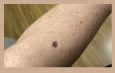 Melanoma in Situ – What is it and How did it affect me?